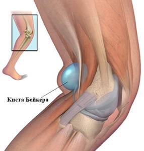 Киста Бейкера коленного сустава: причины, лечение, симптомы, фото