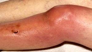 Инфекционный - септический артрит суставов: признаки и лечение