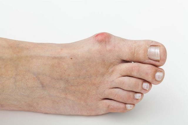Болит косточка на ноге около большого пальца: лечение, причины