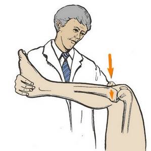 Разрыв задней крестообразной связки: симптомы и лечение коленного сустава
