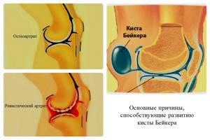 Киста коленного сустава: лечение, симптомы, виды кисты
