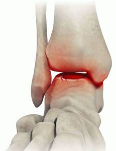 Гнойный артрит коленного и голеностопного суставов: симптомы и лечение