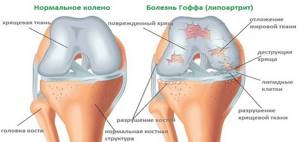 Болезнь Гоффа коленного сустава: лечение, симптомы, причины