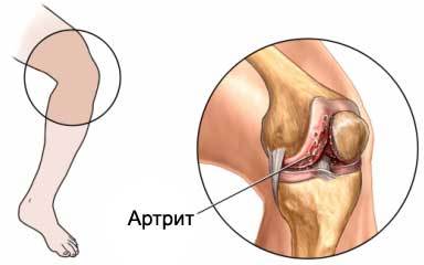 Посттравматический артрит суставов: как избежать, диагностировать и лечить