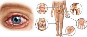 Реактивный артрит: симптомы и лечение, причины заболевания