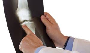 Гигрома коленного сустава: симптомы и лечение