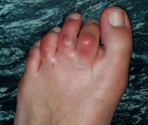 Воспаление сустава большого пальца ноги: причины и лечение