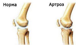 Эндопротезирование коленного сустава, отзывы после операции