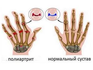 Полиартрит пальцев рук: лечение народными средствами