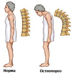 Разница между остеопенией и остеопорозом: перечень отличий