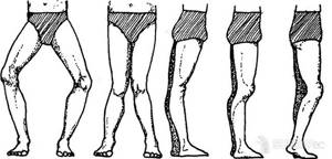 Вальгусная деформация коленных суставов у детей и взрослых