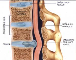 Лечение остеохондроза пояснично-крестцового отдела позвоночника