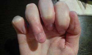 Ревматоидный артрит пальцев рук: первые симптомы, лечение, диагностика