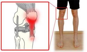 Боли после эндопротезирования коленного сустава, это нормально