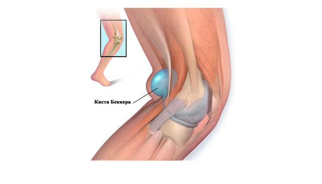 Как лечить бурсит коленного сустава в домашних условиях