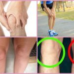 Деформирующий артроз коленного сустава: симптомы, лечение 1, 2, 3 степени