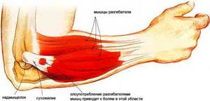 Боль в локтевом суставе: причины, лечение, что делать, чем лечить боли в локте