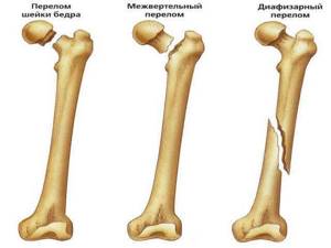Видео: лечение и профилактика переломов шейки бедренной кости