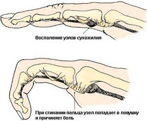Как лечить суставы пальцев рук в домашних условиях