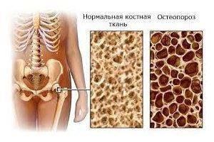 Ломота в костях и суставах: причины и лечение
