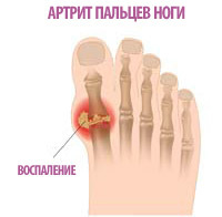 Артрит пальцев ног: симптомы и способы лечения