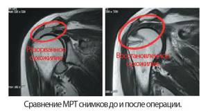 МРТ плечевого сустава: как делают, что показывает, расшифровка