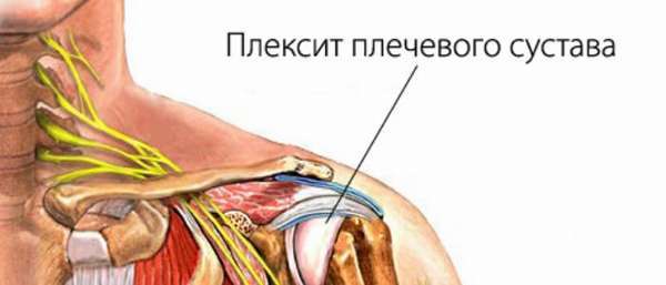 Плексит плечевого сустава: симптомы, лечение плексита плечевого сплетения
