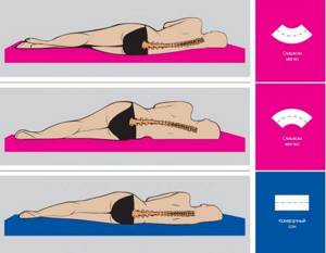 Как правильно спать при шейном остеохондрозе: на какой подушке, в какой позе