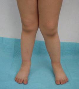 Артроз коленного сустава 3 степени: лечение, симптомы, причины