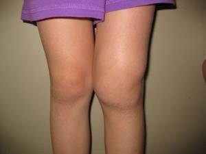 Артрит коленного сустава: симптомы и лечение, причины заболевания