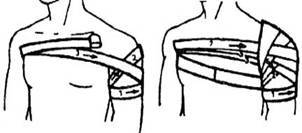 Колосовидная повяза плечевого сустава, техника бинтования