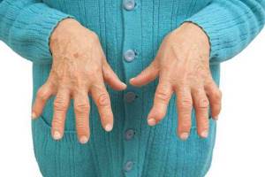 Ревматизм суставов: что такое, симптомы и лечение, отличия от ревматического