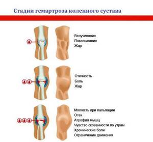 Гемартроз коленного сустава: лечение, симптомы, что это такое