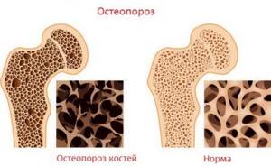 Лечение симптомов остеопороза поясничного отдела позвоночника