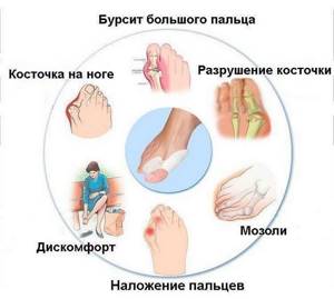 Болит большой палец на ноге в суставе: как лечить и чем, причины боли