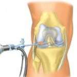 Артроскопия коленного сустава: что это такое, техника операции, отзывы