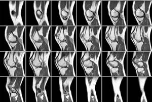 МРТ коленного сустава: что такое, что показывает, как делают