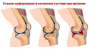 Эндопротезирование коленного сустава, операция, показания и противопоказания