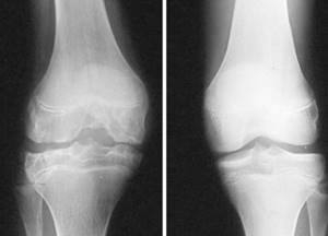 Боли в суставах ног: причины и лечение. Почему болят суставы ног?