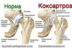 Боль в тазобедренном суставе, отдающая в ногу: лечение, причины