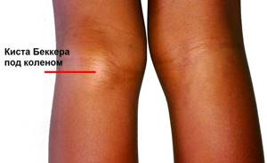 Киста Бейкера коленного сустава: лечение в домашних условиях народными средствами