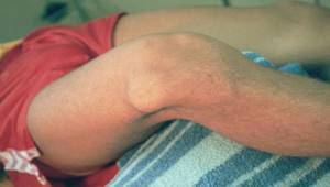 Синовиальный хондроматоз коленного сустава: симптомы и лечение