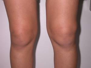 Массаж коленного сустава при артрозе: видео, фото, как делать
