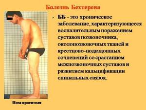 Гимнастика Евдокименко: артроз тазобедренных суставов