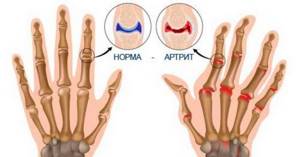 Признаки ревматоидного артрита у женщин: отличия от мужчин