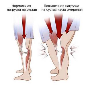 Диета при заболеваниях коленных и тазобедренных суставов