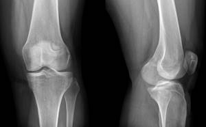 Артроз коленного сустава 4-й степени: лечение без операции не избежать