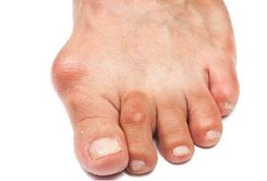 Воспаление сустава большого пальца ноги: причины и лечение