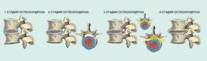 Зарядка при остеохондрозе грудного отдела позвоночника: польза и вред