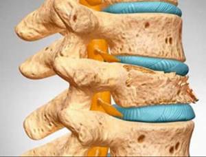 Лечение остеоартроза суставов и позвоночника в домашних условиях